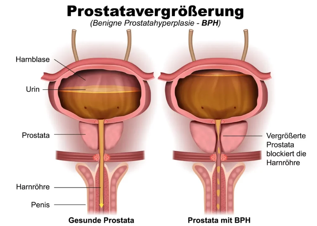 Prostatavergrößerung: Ursachen, Symptome & Tipps